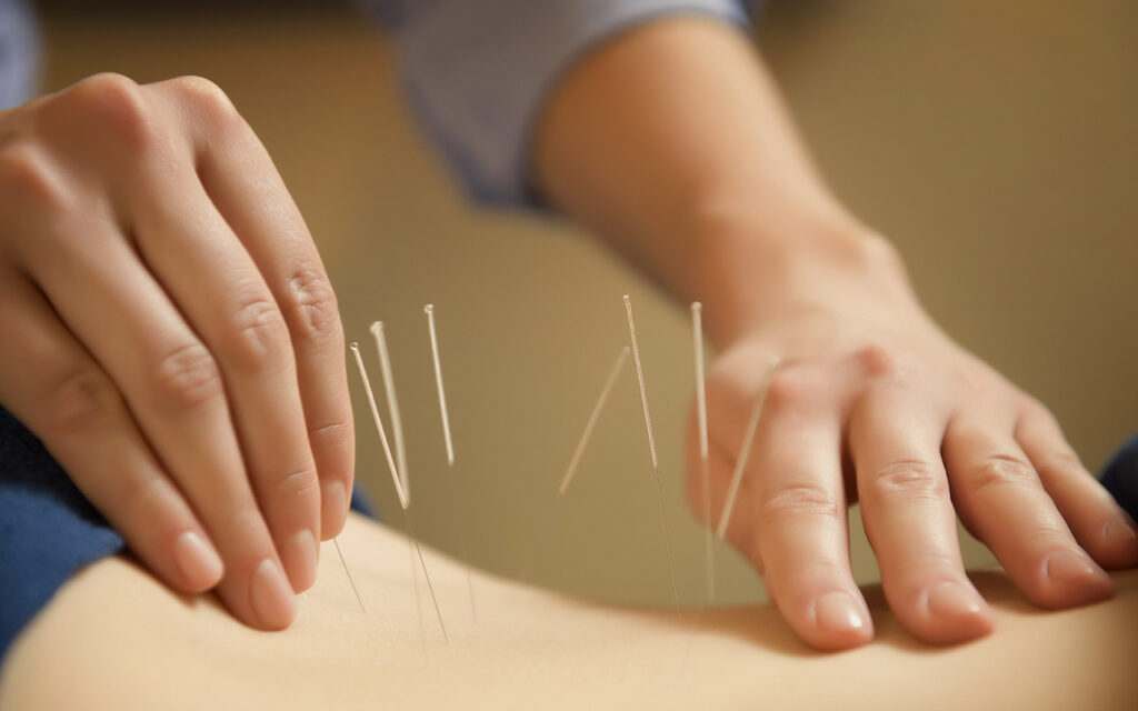 Acupuncture Benefits: Your Guide to Holistic Healing”