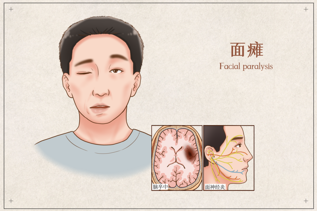 How Does TCM Acupuncture Help Facial Paralysis?