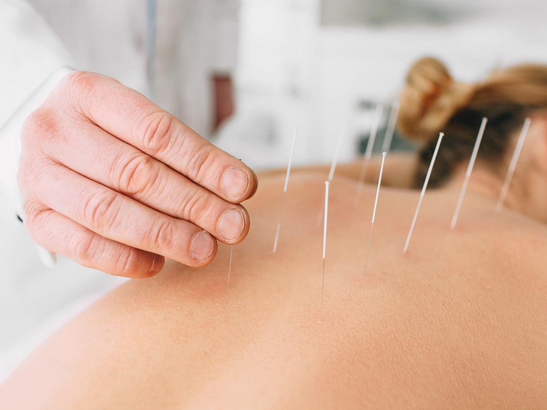 acupuncture