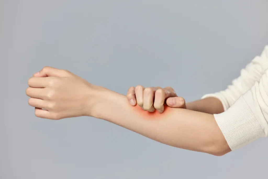 TCM Eczema