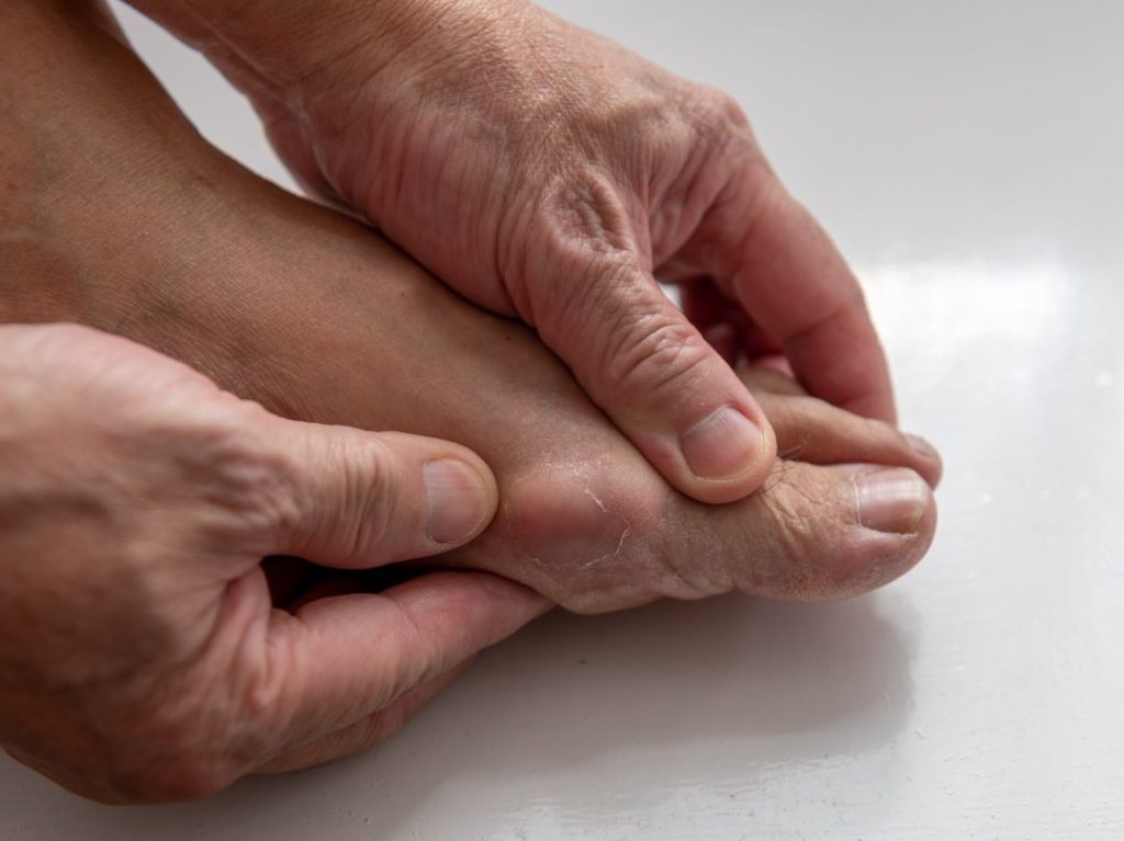 tcm gout